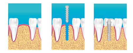 Implant Dentiste paris 15 eme